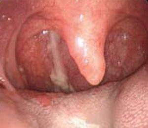 Drainage In The Throat 9